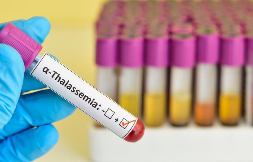 Akola GMC does not have medicines for thalassemia patients! | थॅलेसीमिया रुग्णांसाठी ‘जीएमसी’त औषधेच नाहीत!