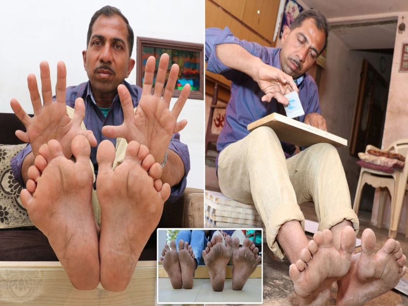 The man with the most fingers and toes in the world Devendra Suthar has 28 fingers | २८ बोटं असलेल्या देवेंद्रचं गिनीज बुकमध्ये नाव, मात्र जगण्याचा संघर्ष सुरूच!