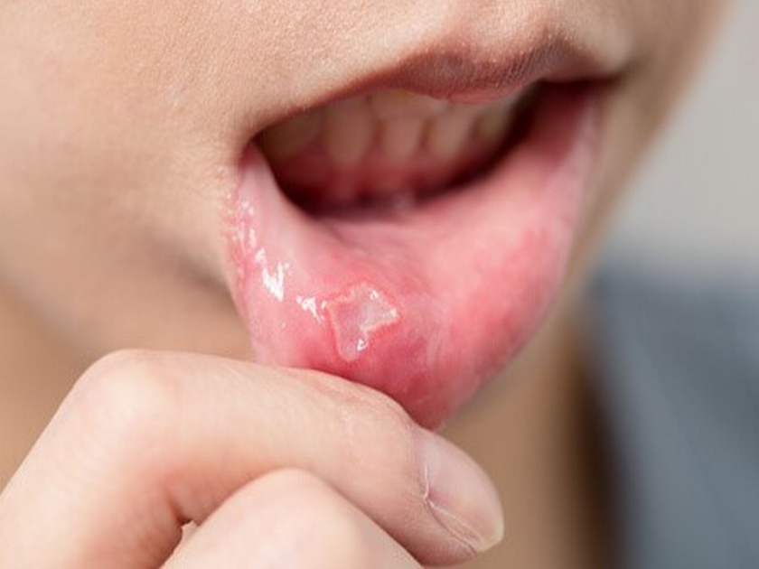 You Should know home remedies to treat mouth ulcer | तोंडात आलेल्या फोडांमुळे काहीच खाता-पिता येत नसेल तर करा 'हे' घरगुती उपाय!