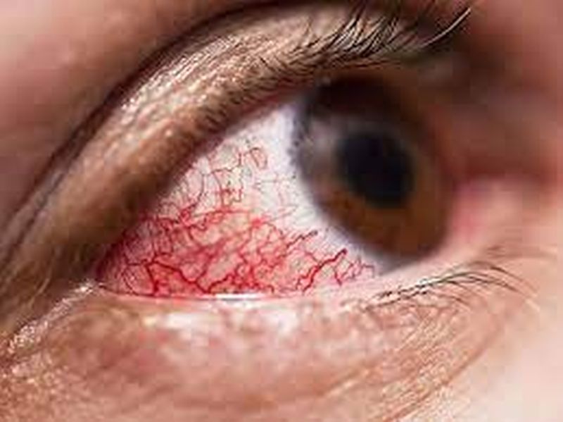 Mucormycosis : The eye had to be remove to save lives of patients | Mucormycosis : जीव वाचविण्यासाठी गमवावा लागला डोळा