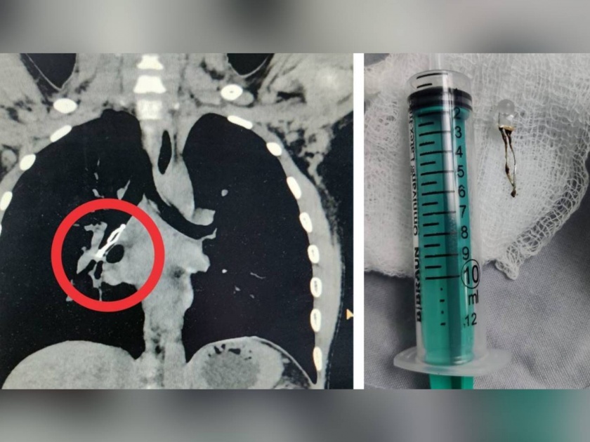 led bulb removed from 9 year olds lungs | बापरे! ९ वर्षीय मुलाच्या फुफ्फुसातून बाहेर काढला LED बल्ब!