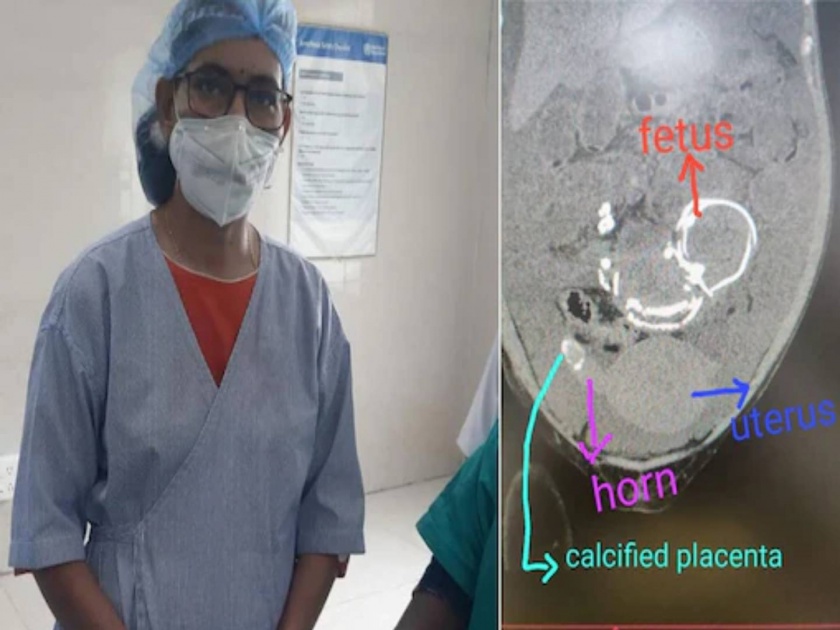 rare stone baby surgically removed from 26 year old woman in raipur | पोटदुखीची तक्रार घेऊन डॉक्टरकडे गेली महिला; दुर्मीळ स्टोन बेबी पाहून डॉक्टर चक्रावले