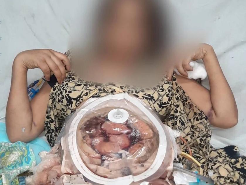 gwalior acid attack victim made a video before death | धक्कादायक! सुखी संसाराचं स्वप्न भंगलं; हुंडा न आणल्यानं सासरच्यांनी विवाहितेला अ‍ॅसिड पाजलं