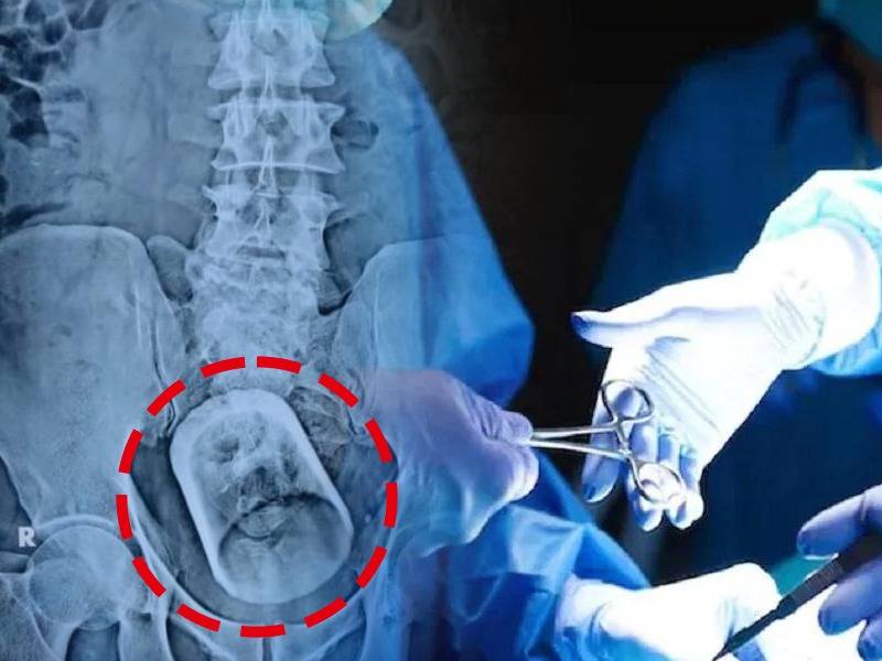 glass removed from stomach of 55 year old man in muzaffarpur bihar | डॉक्टरांनी रुग्णाच्या पोटातून काढला काचेचा ग्लास; त्याचा दावा ऐकून डोक्यावर मारला हात
