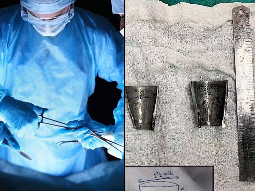 Doctors saved mans penis with help of gas cutter in jj hospital | विचित्र जागी अडकलं होतं गुप्तांग; जेजे हॉस्पिटलच्या डॉक्टरांनी जीव वाचवला!