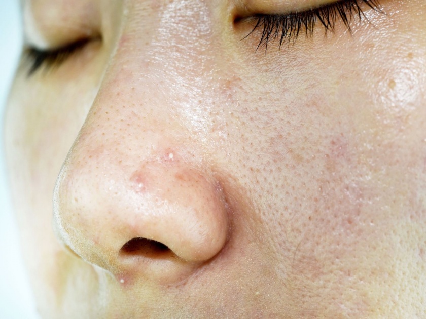 Oily and acne prone skinface packs for oily skin | तेलकट त्वचेमुळे हैराण आहात?; मग 'हे' फेसपॅक नक्की ट्राय करा!
