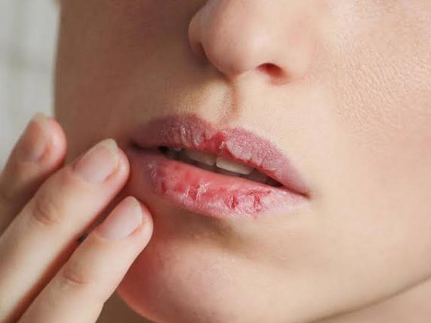 Lip cracks in winter make your face look worse These tips for beautiful lips | हिवाळ्यात फाटलेल्या ओठांमुळे चेहऱ्याचा लूक बिघडतोय? या टिप्सने कोरड्या ओठांसह काळपणा होईल दूर