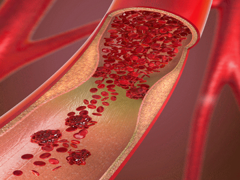 Cholesterol accumulated in the veins, know how control cholesterol | सावधान! हृदयाचे ठोके थांबवू शकतं नसांमध्ये जमा असलेलं कॉलेस्ट्रॉल, जाणून घ्या उपाय 