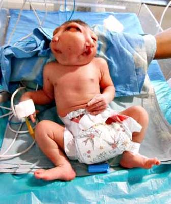 The birth of two oral baby in Khamgaon | खामगावात दोन तोंडी बालकाचा जन्म