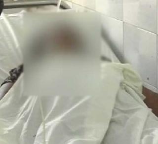 Fourth attack on gangrape victim | गॅंगरेप पीडितेवर चौथ्यांदा झाला अॅसिड हल्ला
