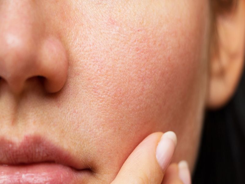 how to cure open facial pores lemon and coconut oil | चेहऱ्यावरील ओपन पोर्सने त्रस्त आहात? 'हा' उपाय ठरेल फायदेशीर!