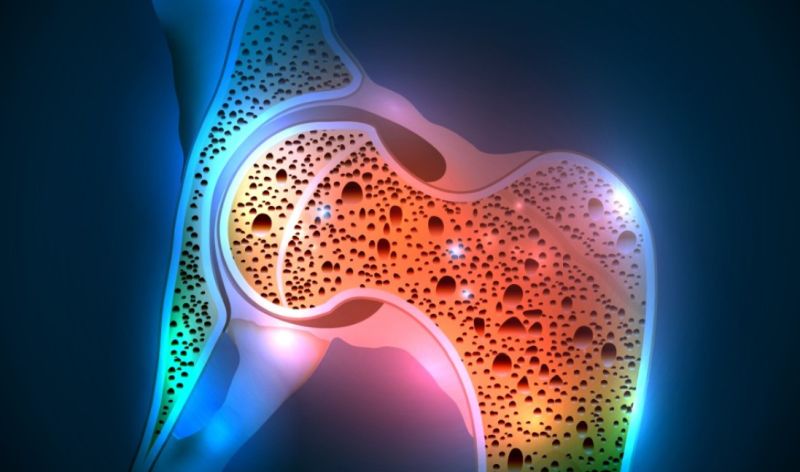 Bone thickening increases the risk of 'osteoporosis'! | हाडांच्या ठिसुळतेमुळे वाढतोय ‘आॅस्टियोपोरोसिस’चा धोका!