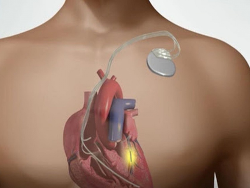 Pacemakers help maintain a regular heart rate | पेसमेकरमुळे हृदयाची गती नियमित राखण्यास मदत