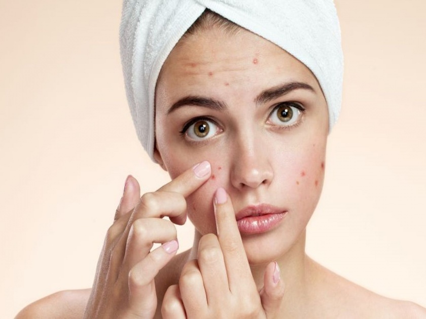 Home remedies for get rid off pimples | कोणत्याही महागड्या प्रॉडक्टने नाही तर 'या' घरगुती उपायांनी रात्रीतून दूर करा पिंपल्स! 