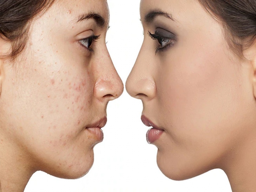 Tips to keep away acne in monsoon or potato or sugar pack to fight acne in monsoon | मान्सूनमध्ये पिंपल्स आणि अ‍ॅक्ने दूर करण्यासाठी वापरा 'या' घरगुती टिप्स!