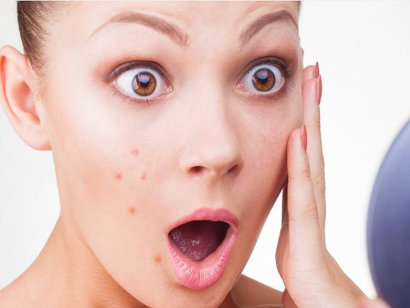 New research says that acne on face may cause depression symptoms | पिंपल्समुळे होऊ शकते 'ही' गंभीर समस्या; वेळीच व्हा सावध