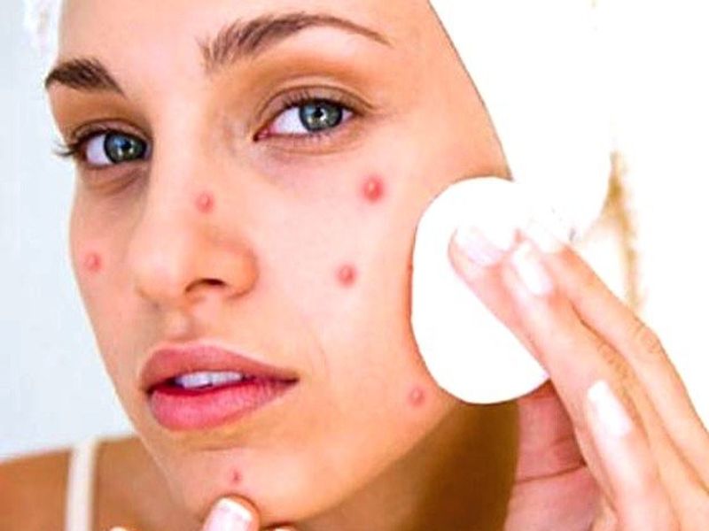Why does acne appear during monsoon tips to stay protected | ...म्हणून पावसाळ्यात उद्भवते पिंपल्स आणि अ‍ॅक्नेची समस्या; अशी करा दूर