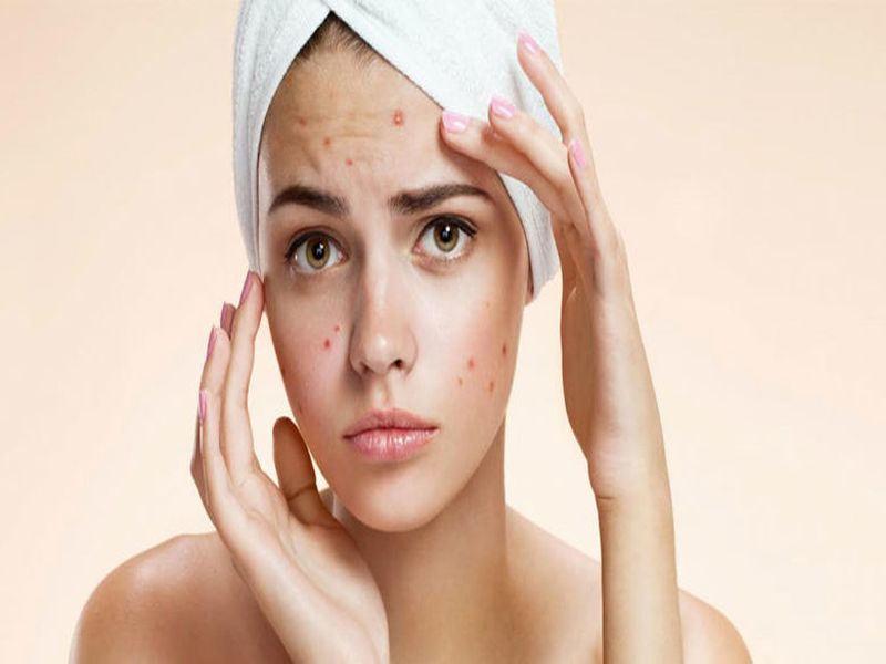 Acne or pimples problem can be also due to these 4 reasons | 'या' 4 चुका ठरतात पिंपल्स येण्यासाठी कारणीभूत!