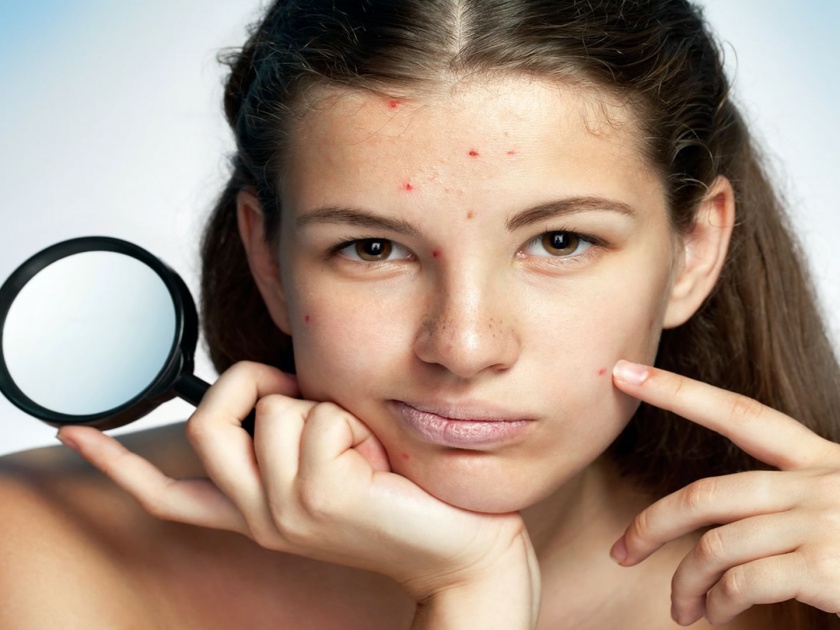 If you want to get rid of pimples then follow these home remedies | पिंपल्समुळे हैराण आहात?; 'या' घरगुती उपायांनी करा दूर