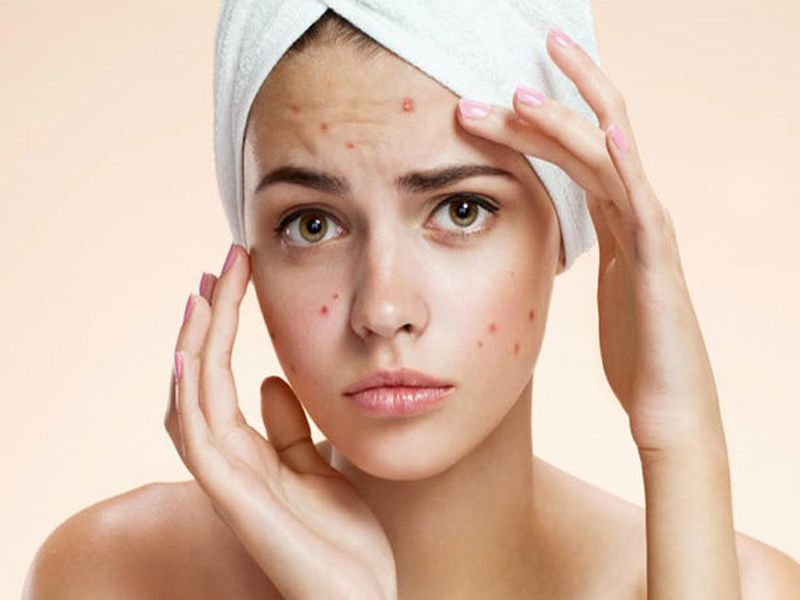 Troubled by pimples on the face? Do this home remedy, to get rid of both pimples and anxiety | चेहऱ्यावरील पिंपल्समुळे त्रासला आहात? हे घरगुती उपाय करा, पिंपल्स आणि चिंता दोन्ही दूर