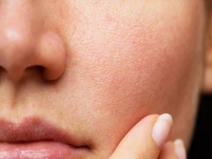 Why facial pores become big and how to remove them? | चेहऱ्यावरील रोमछिद्रे मोठी का होतात आणि कसे दूर करायचे याचे डाग?