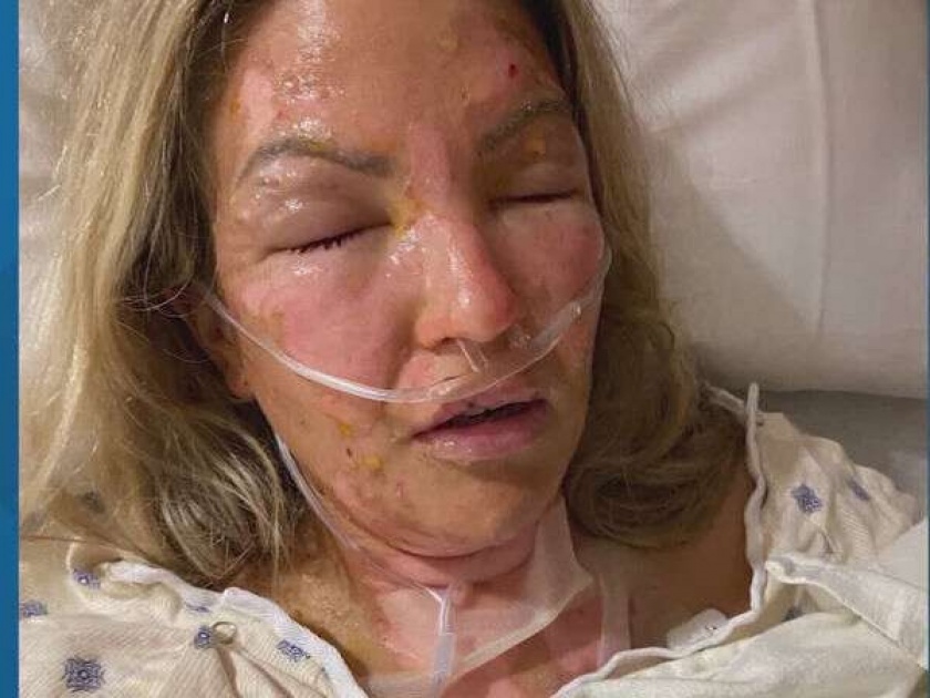 Hand sanitizer explodes in Texas woman admited in ICU | महिला पेटवत होती मेणबत्ती, हॅंड सॅनिटायजरमुळे अचानक झाला स्फोट आणि...