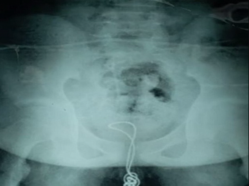 Chinese Boy Inserts 2ft-Long Metal Wire Into His Genitals To See Where Urine Comes From | ...म्हणून 'या' मुलाने प्रायव्हेट पार्टमध्ये टाकली दोन फूट लांब धातुची वायर, वाचा पुढे काय झालं?