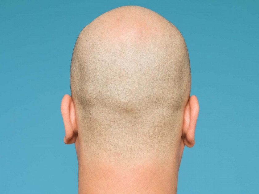 Bald men are up to 2-5 times more likely to suffer severe covid 19 says study/ | Corornavirus : टक्कल असलेल्या लोकांना कोरोनाचा जास्त धोका, अधिक गंभीर आजारी पडण्याचा रिसर्चमधून दावा