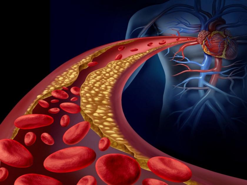 Is the blood lipid level rising? Can cause serious illness; Is related to the heart | रक्तातील लिपिडस्तर वाढतोय? होऊ शकतो हा गंभीर आजार; हृदयाशी आहे संबंधित