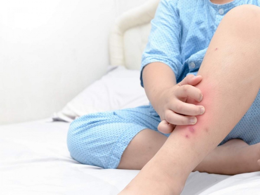 Coronavirus : These skin symptoms could be sign of misc in kids | कोरोनातून बरे झालेल्या लहान मुलांमध्ये दिसतील ही लक्षणे, तर वेळीच व्हा सावध; फेल होऊ शकतात ऑर्गन