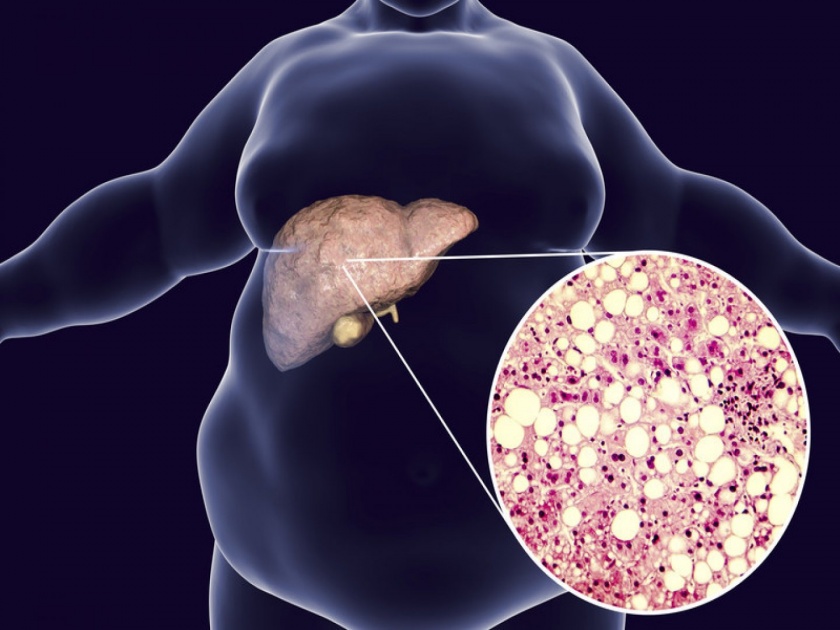 Pay attention to the liver in time, otherwise fatty liver can occur, know the symptoms and remedies | लिव्हरकडे वेळीच लक्ष द्या, नाहीतर होऊ शकतो फॅटी लिव्हर, जाणून घ्या लक्षणं अन् उपाय
