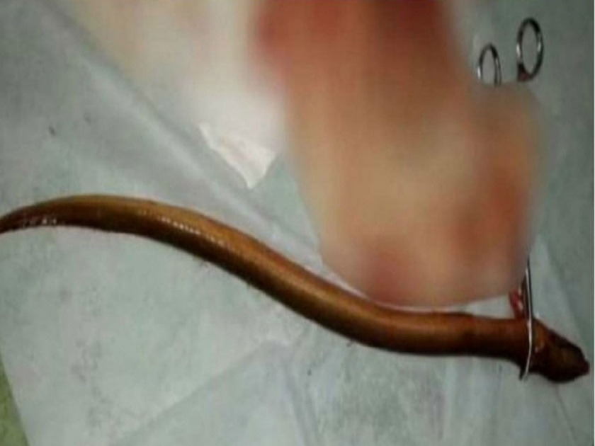 Shocking! Man inserts eel fish into rectum from anus in hopes to relief constipation | बोंबला! पोट साफ करण्यासाठी केला त्याने विचित्र उपाय, पार्श्वभागातून शरीरात सोडला मासा आणि मग....