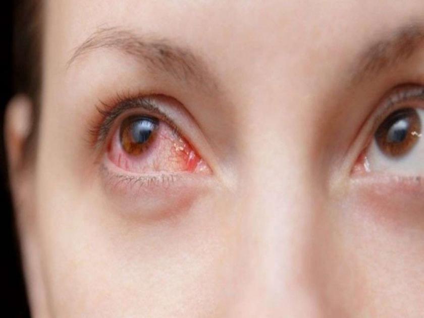 Corona New Symptoms : Red eyes and rapid hair loss may be symptoms of corona | Corona New Symptoms: समोर आली डोळे आणि केसांसंबंधी कोरोनाची २ नवी लक्षणं, तुम्हीही करा चेक