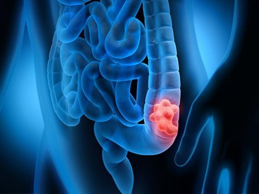 Colon Cancer Symptoms : Warning signs and symptoms of colon cancer in stool | Colon Cancer Symptoms : काय असतात कोलोन कॅन्सरची लक्षणं? दुर्लक्ष केलं तर पडेल महागात!