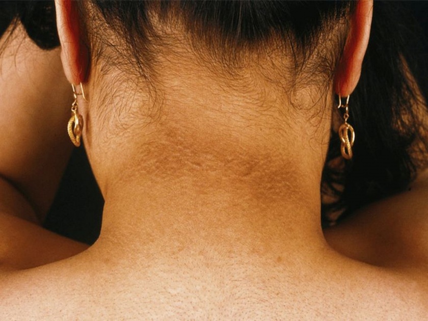 Skin Care : Tips get rid dark neck instantly | मानेवरील काळपटपणा घालवण्यासाठी करा हे घरगुती उपाय, एकदा कराच मग बघा कमाल...
