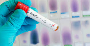 not to believe in rumors; Give children rubella vaccine! | अफवांवर विश्वास न ठेवता मुलांना द्या गोवर, रुबेला लस!