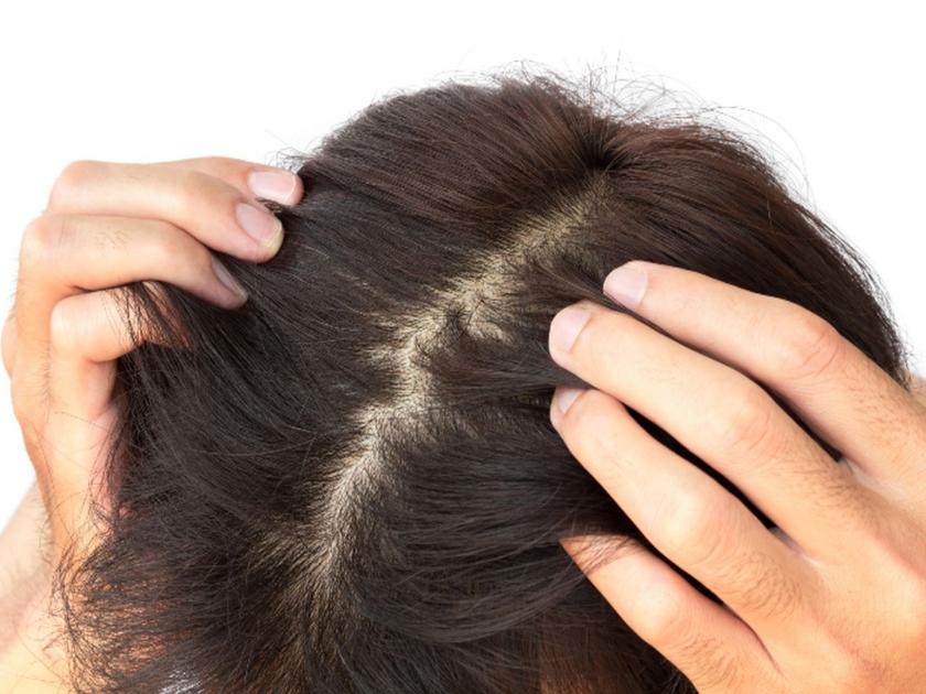 Facing itching problem in scalp try these useful home remedies | दूर करण्यासाठी घामामुळे डोक्याला होणारी खाज 'हे' ३ उपाय करा आजच्या आज!