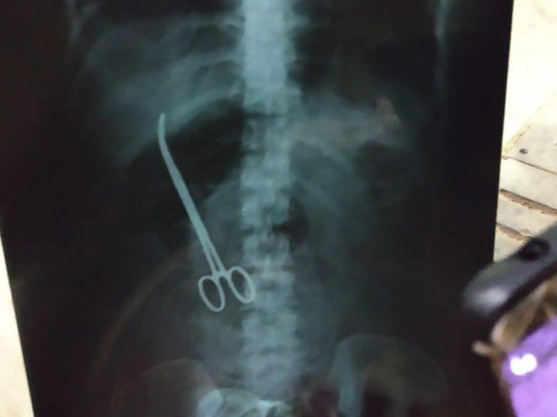 Hyderabad: Doctors forget scissors inside patient’s stomach, acute pain reveals lapse | बापरे... ऑपरेशननंतर 3 महिने महिलेच्या पोटातच होती कात्री! 