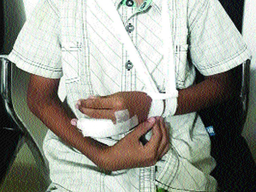 Student's finger broken in school accident | शाळेतील अपघातात विद्यार्थ्याचे बोट तुटले