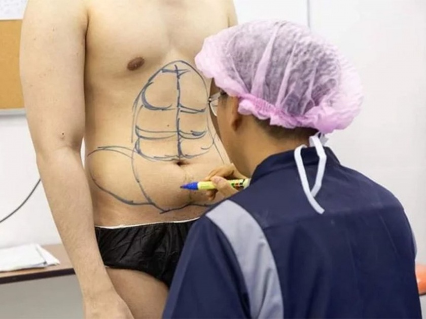 Thailands hospital offers instant six-pack abs and the process looks painful | काही तासांमध्येच बनवून मिळतात Six-Pack Abs, जाणून घ्या अजब पद्धत