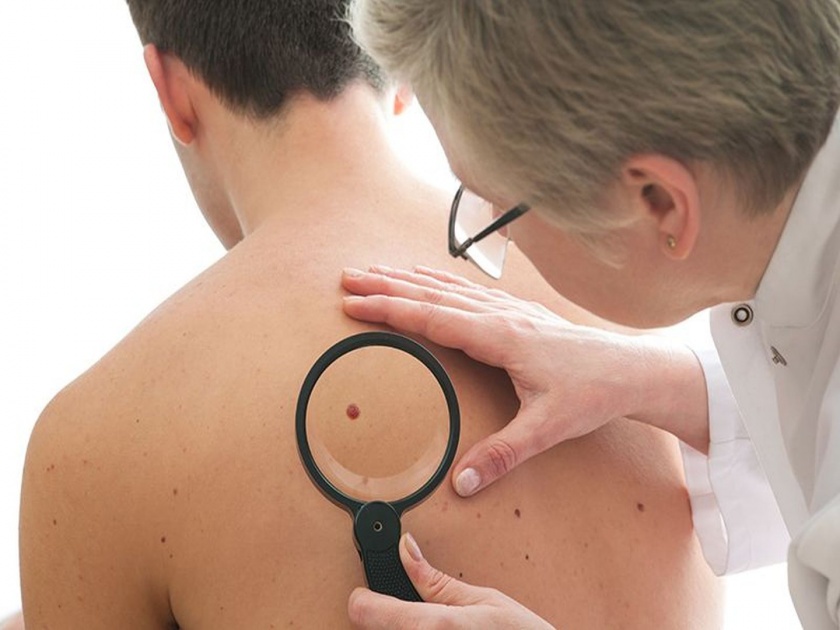 These are symptoms of skin cancer | 'ही' असू शकतात स्किन कॅन्सरची लक्षणं; दुर्लक्षं करणं पडू शकतं महागात