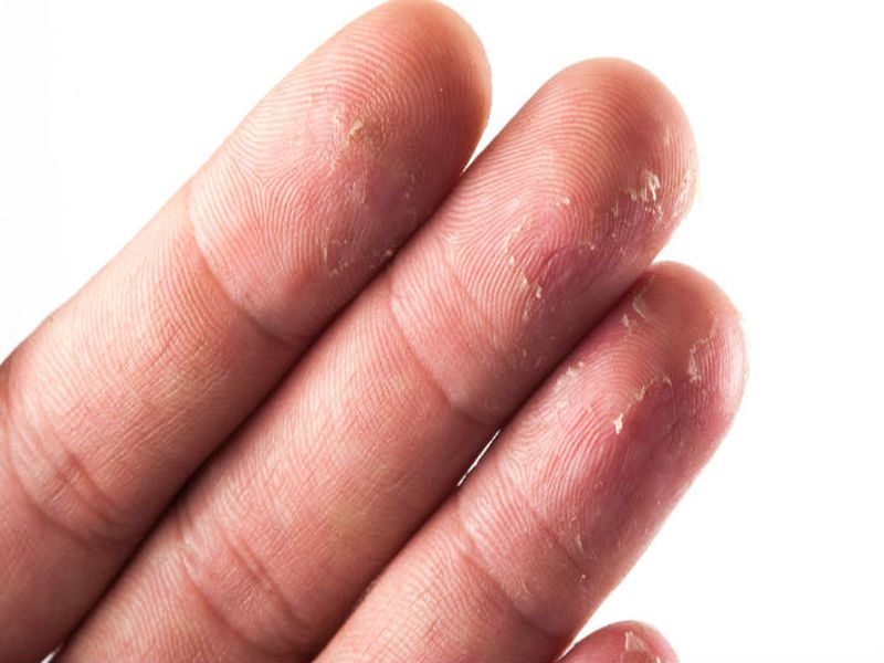 home remedy to get rid of hand skin peeling | हाताला स्कीन पीलिंगचा त्रास होत असेल तर 'हे' उपाय करा!
