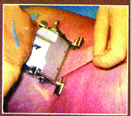 Dermatitis Movement in Sangli ... | सांगलीमध्ये रूजतेय त्वचादानाची चळवळ...; वर्षभरात चार बालकांना मिळाले जीवदान