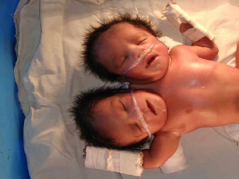 The two-headed baby born in the civil hospital of Solapur | सोलापूरच्या सिव्हील रुग्णालयात जन्मले दोन डोक्यांचे बाळ