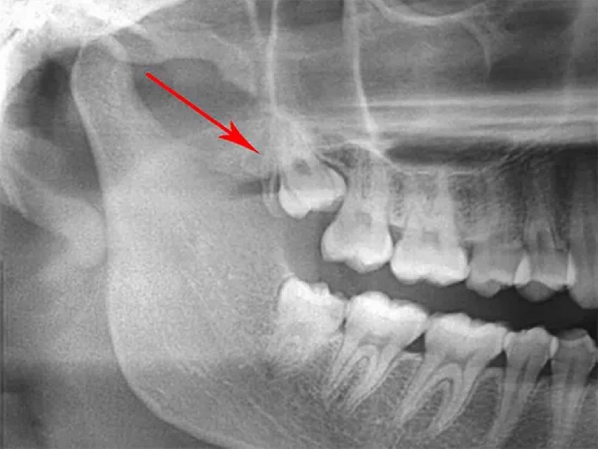 Removed the jaw with chucky teeth and placed a new one; Consequences of severe myocardial infarction | चक्क दातांसह जबडाच काढून नव्याने बसविला; गंभीर म्युकरमायकोसिसचा परिणाम