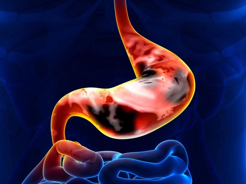 Symptoms of stomach cancer and cause | 'या' समस्या सतत उद्भवत असतील तर सावध व्हा; पोटाच्या कॅन्सरची असू शकतात लक्षणं
