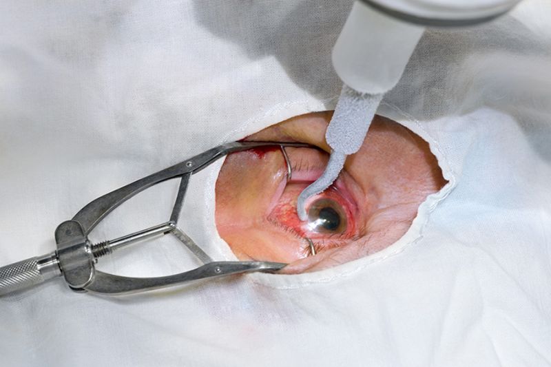 Surgical retinal surgery closed in Mayo, Medical | मेयो, मेडिकलमध्ये सर्जिकल रेटीनाच्या शस्त्रक्रिया बंद