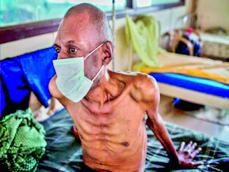 tb and leprosy found; 4,000 patients in the district | क्षय, कुष्ठरोग आढळला; जिल्ह्यामध्ये ४ हजार रुग्ण