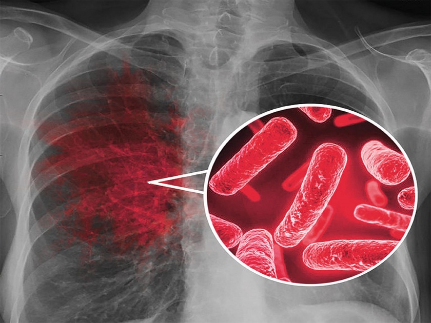 Tuberculous infection is not life-long in most people says research | टीबीचं इन्फेक्शन हे काही लोकांमध्ये आयुष्यभरासाठी नसतं - रिसर्च