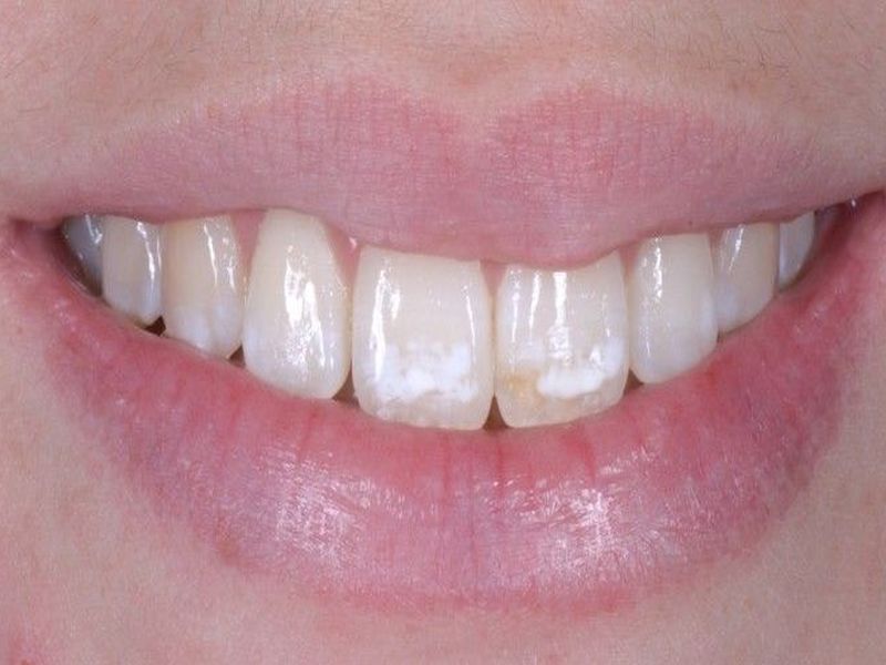 Teeth and spots fluorosis, know symptoms and causes | दातांवर दिसणारे पांढरे डाग असू शकतात 'या' आजाराचे संकेत! 